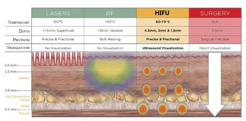 Ultra Skin Hifu/ Hifu Skin Lifting Ultra Sound Technology/ Hifu Body Body and Face Treatments