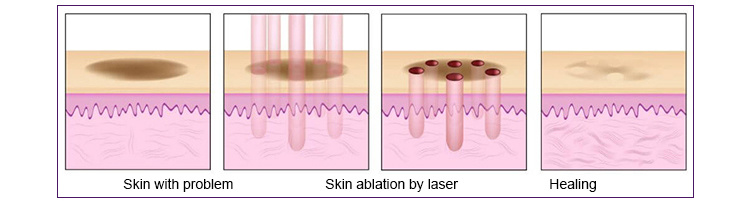 RF Metal Tube Laser Fractional CO2 Acne Treatment Electronic Technology Vaginal Tightening CO2 Fractional Laser