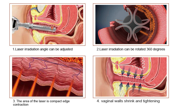 CO2 Fractional Laser Tighten Vagina Beautify Vagina Medical Beauty Equipment / Fractional CO2 Laser Machine