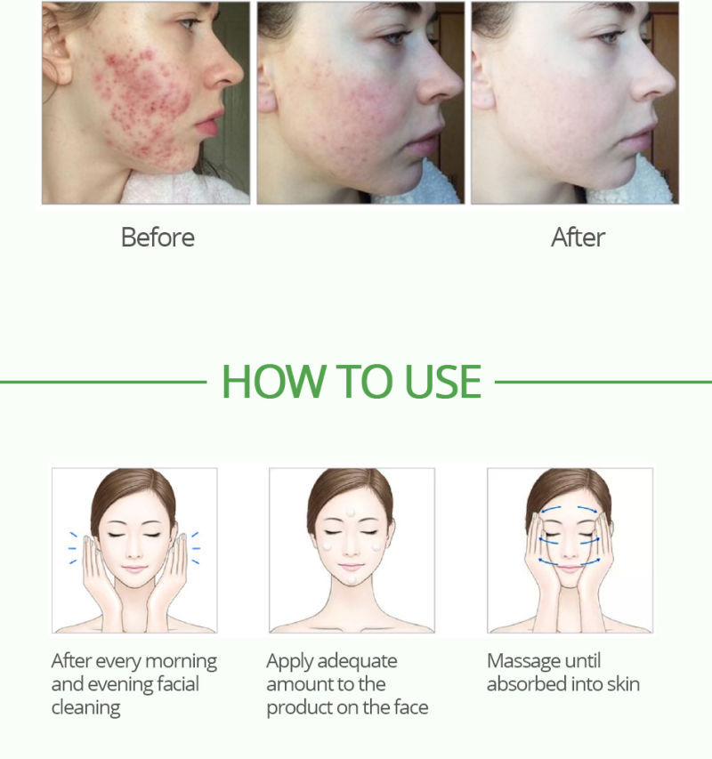 Mslam Acne Treatment Blackhead Removal Anti Acne Cream Oil Control Shrink Pores Acne Scar Remove Tea Treeface Care Whitening