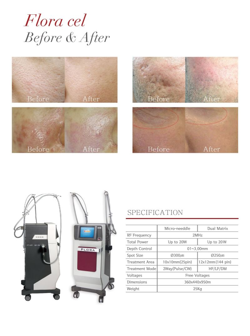 Ruikd Microneedle Fractional RF Beauty Medical Equipment for Wrinkle Removal