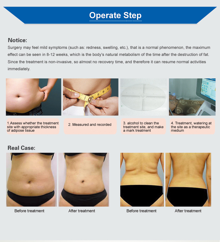 Professional Fat Reducing Liposonix Slimming Machine for Body Slimming