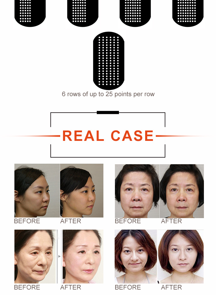 Professional Korea Hifu Focused Ultrasonic Beauty Machine for Wrinkle Removal