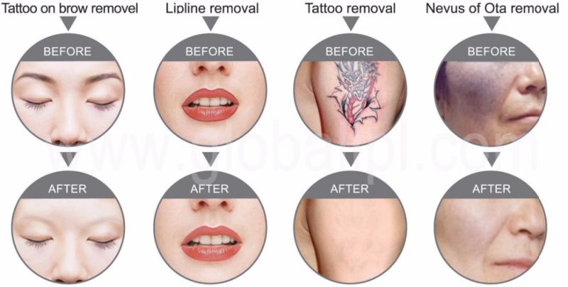 Skin Care Tattoo Removal Salon Eauipment Popular in Europe