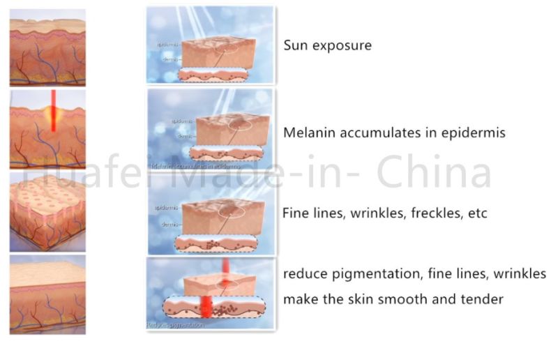 Wrinkle Remover Skin Tightening Fractional CO2 Laser