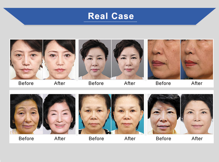Newest Style Anti-Aging / Face Lifting Facial Beauty Hifu Machine