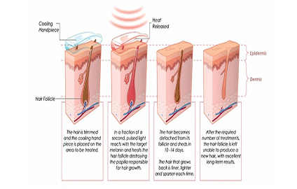 Muilt-Function IPL Diode Laser Permanent Hair Removal Machine