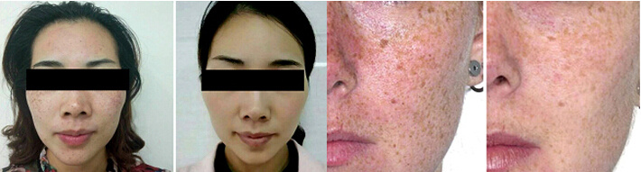 Q Switch ND: YAG Laser Carbon Peeling as Aesthetic Laser Equipment