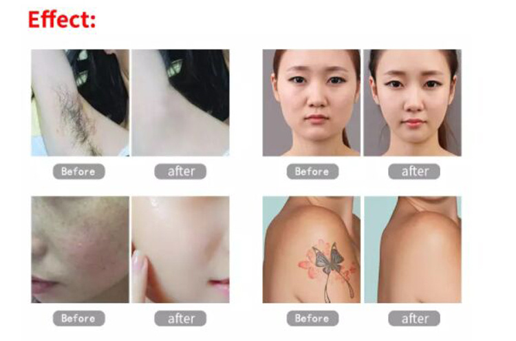 New Style Shr / Opt / Dpl/IPL+ Pico Laser + RF Multifunctional IPL Shr Hair Removal Machine with Cooling