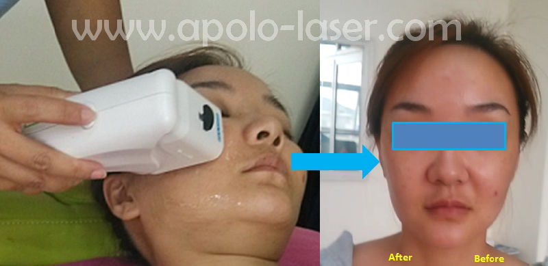 Vertical Hifu Face Lifting Anti Ageing Beauty Machine by Apolo