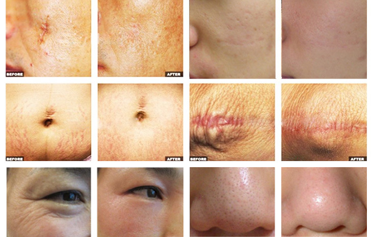 1550nm Wrinkle Removal Beauty Equipment for Beauty Machine