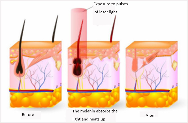 E Laser Hair Removal Beauty Depilation IPL Machine