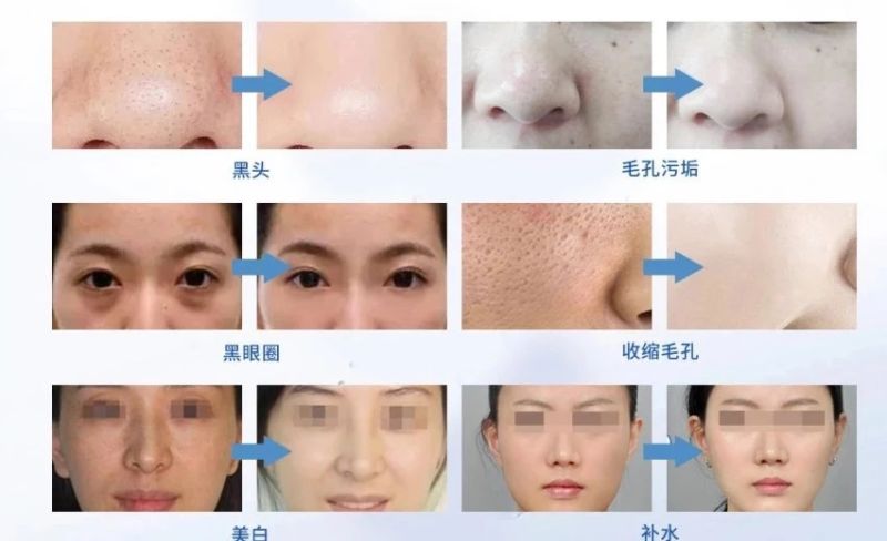 Hydro Dermabrasion Facial Microdermabrasion Beauty Salon Equipment