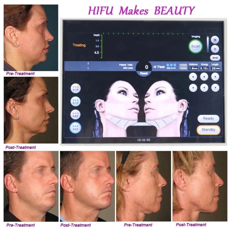 Professional Smas Lifting Anti-Aging Anti-Wrinkle Face Lifting Hifu Machine