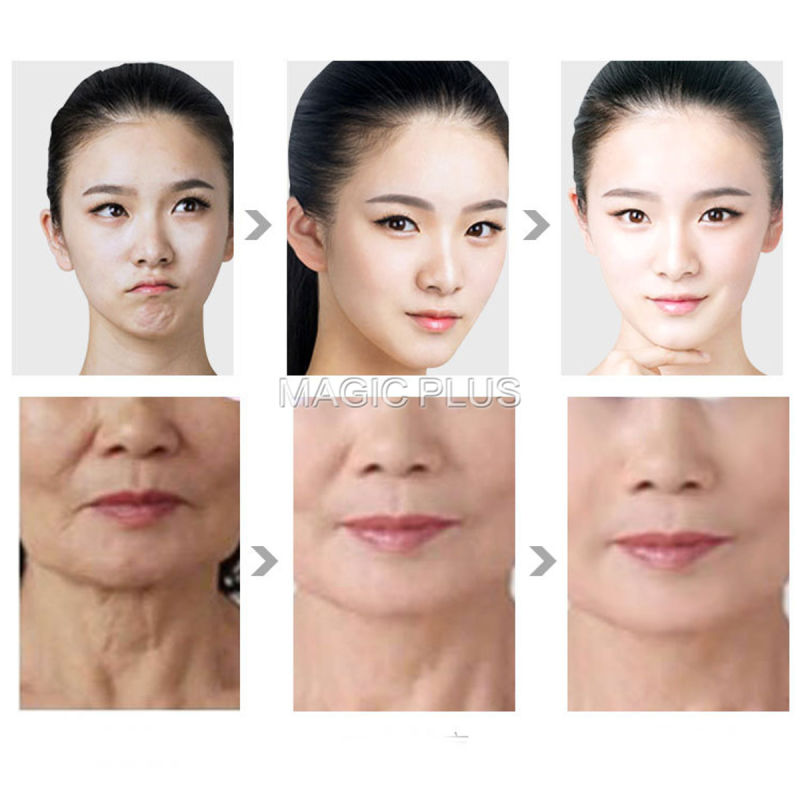 Vmax Hifu Anti-Wrinkle Machine Home Use Face Lift Vmax Hifu Beauty Equipment