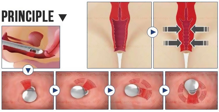 Vca Laser Hifu Vaginal Tightening Beauty Machine