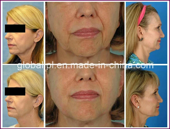 Professional Technology Skin Rejuvenation Hifu Face Lift Machine