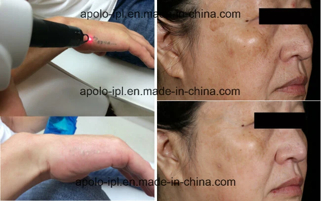Vertical Apolomed IPL Hair Removal Laser Hair Removal