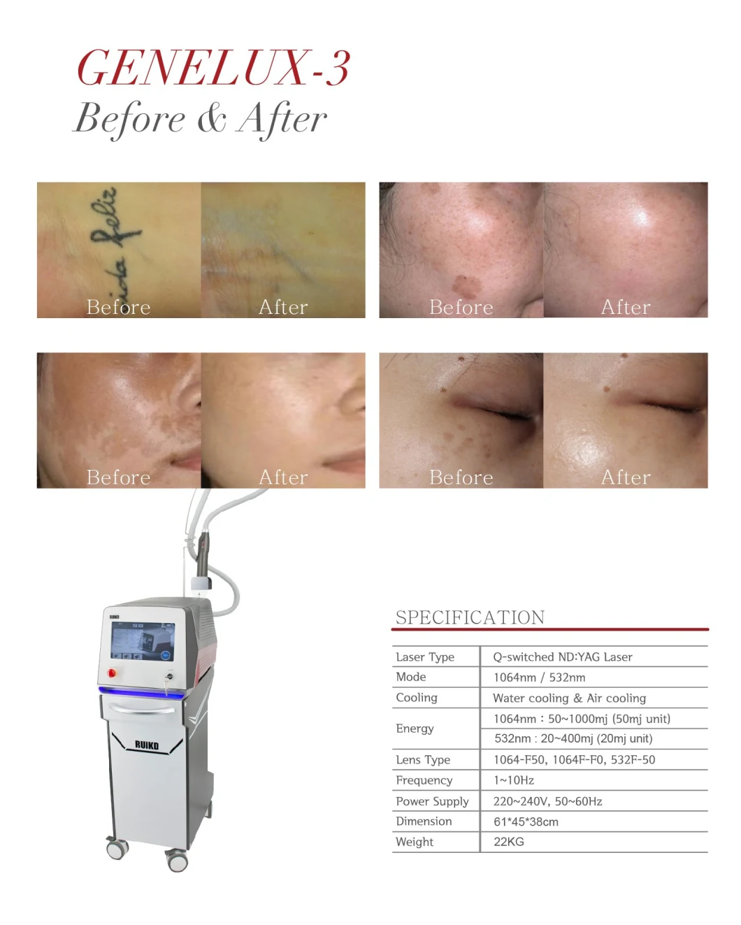 Effective Portable Q-Switch ND YAG Tattoo Removal Laser Beauty Equipment
