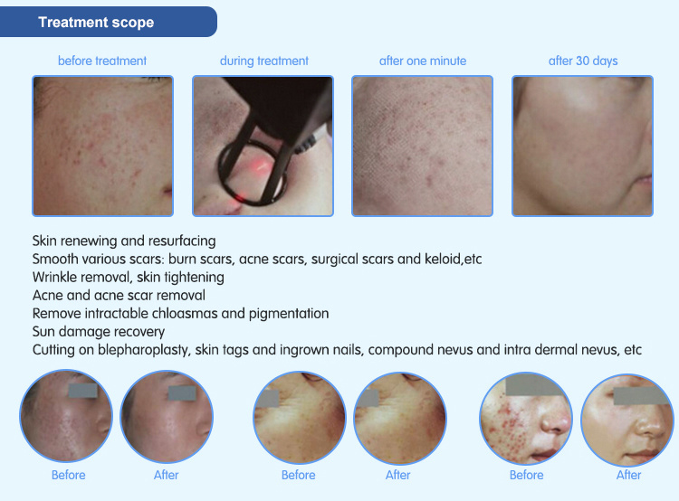 Skin Resurfacing Acne Scar Treatment Laser Equipment CO2 Fractional