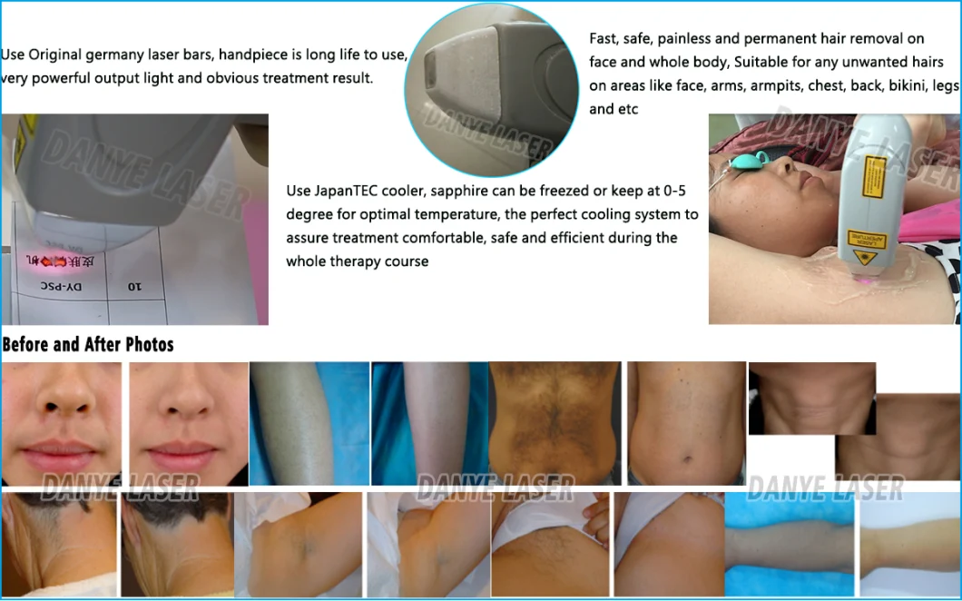 Alexandrite Diode Hair Laser Removal Diode Laser Hair Machine 810 Hair Removal Depilacion Laser