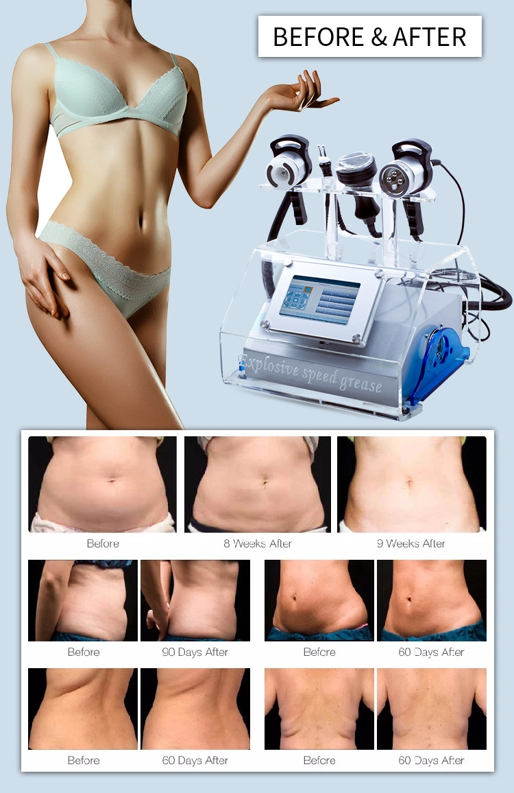 Hot Selling Shock Wave Machine Anti-Cellulite Machine RF Beauty Salon Equipment with Ce Certificate