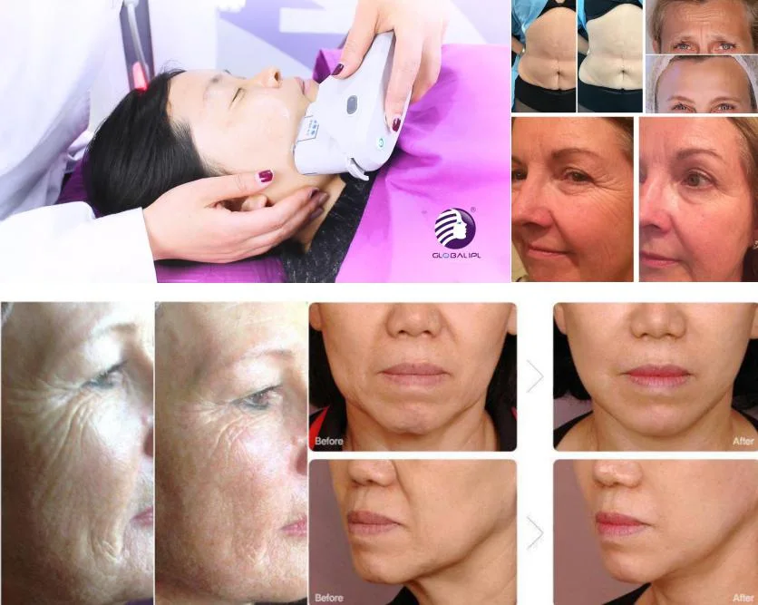 Newest Technology Skin Rejuvenation Hifu Face Lift Machine