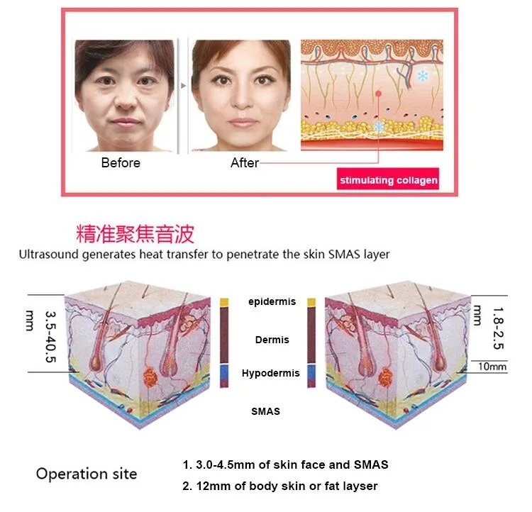 Home Use Portable Vmax Ultrasonic Facial Cleaning Oxygen Facial Device Hifu Beauty Machine