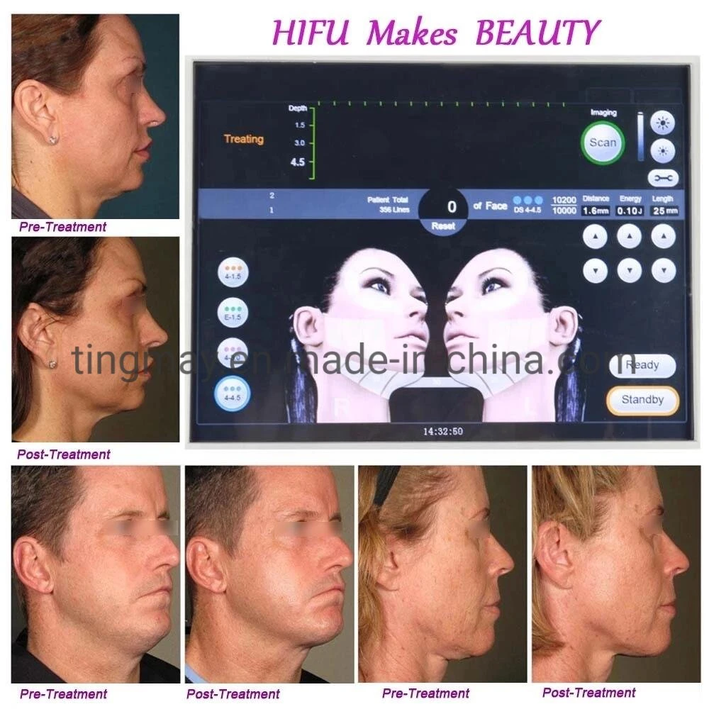 3D Hifu Focused Ultrasound Effective Face Lifting Body Slimming Machine