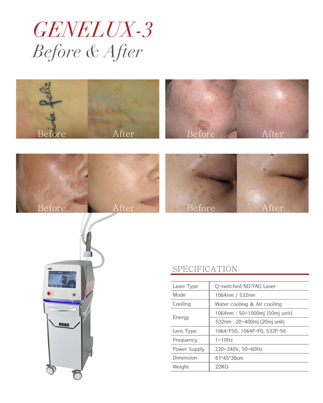 Effective ND YAG Laser Eyebrows Removal Tattoo Removal Medical Device