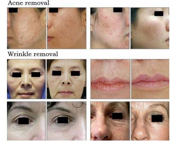 New Arrival CO2 Fractional Laser Skin Resurfacing