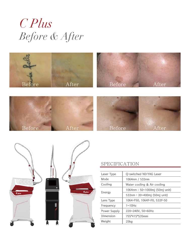 Effective Q-Switch ND YAG Laser Skin Rejuvenation Tattoo Removal Medical Equipment