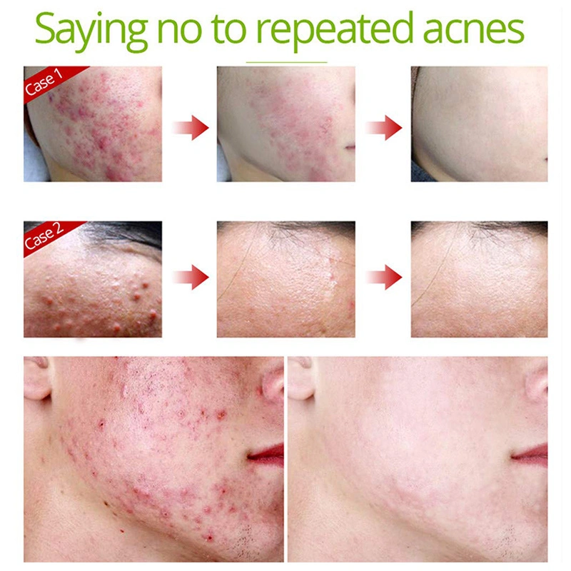 Private Label Acne Removal Pimple Repair Skin Care Tea Tree Acne Treatment Serum