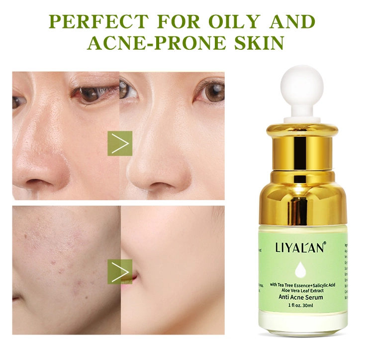in Stock Fast Dispatchkorea Private Label 100% Organic Best Acne Scars Treatment Essence Anti Acne Serum