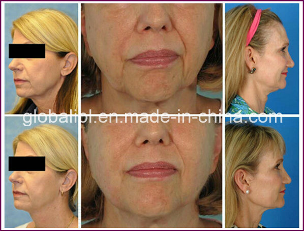 Visible Result One Treatment Skin Rejuvenation Hifu Beauty Machine