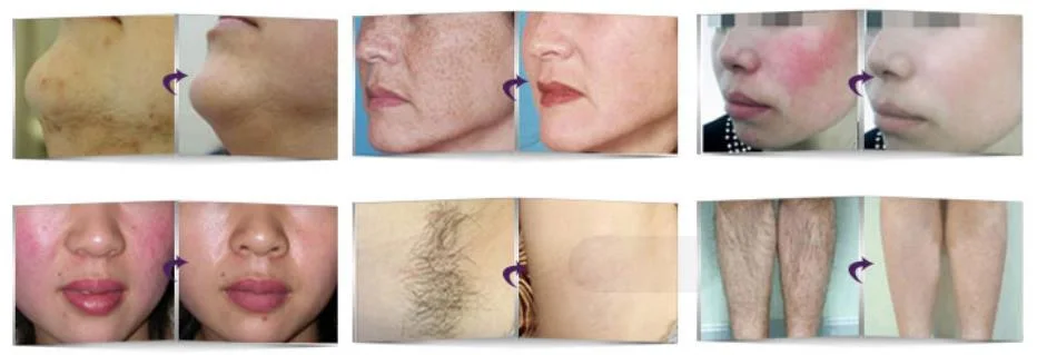Hot Beauty Machine / IPL+ RF (E-light) Beauty Equipment for Hair Removal