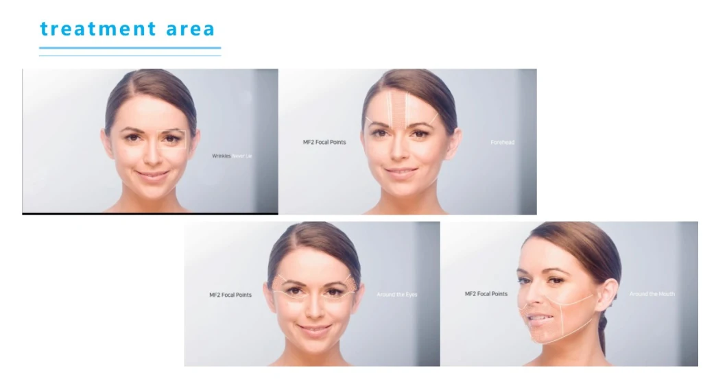 Hot Sales Hifu Cosmetics Max 7D Tratamiento Body Facial Hifu 12 Lignes Home Device