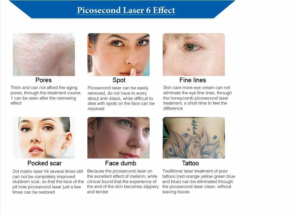 2021 High Effective Picosecond ND YAG Tattoo Removal Laser Device