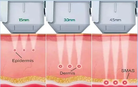 Sincoheren 4D 5D 3D Hifu Machine Hifu Facial and Body for Skin Lifting and Fat Loss