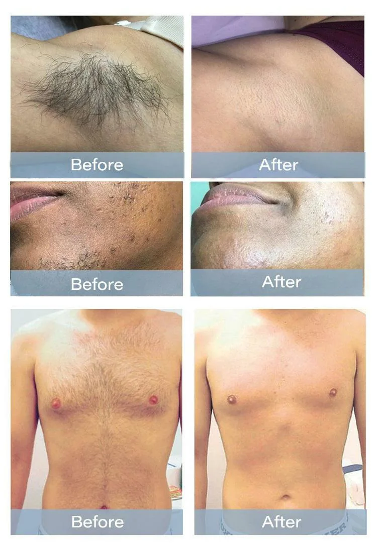 IPL Opt Shr Laser Beauty Machine Hair Removal Acne Treatment Skin Rejuvenation Machine