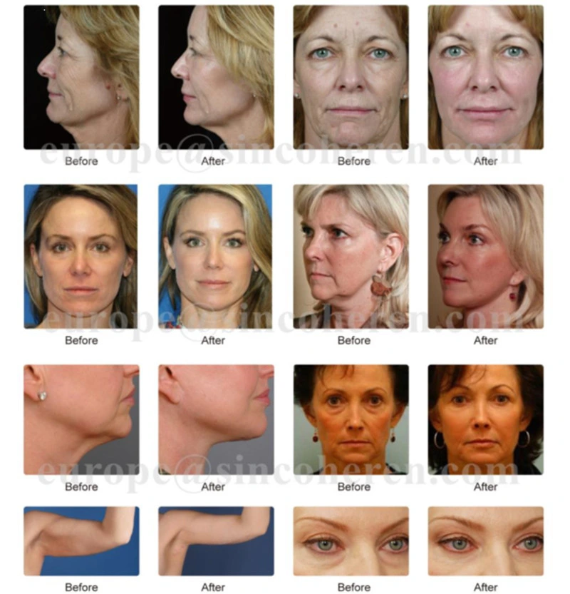 Sincoheren Hifu Liposonix Machine Face Body Slimming Wrinkle Removal