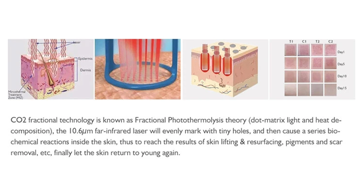 Fractional CO2 Laser Wrinkles Removal and Skin Resurfacing Treatments
