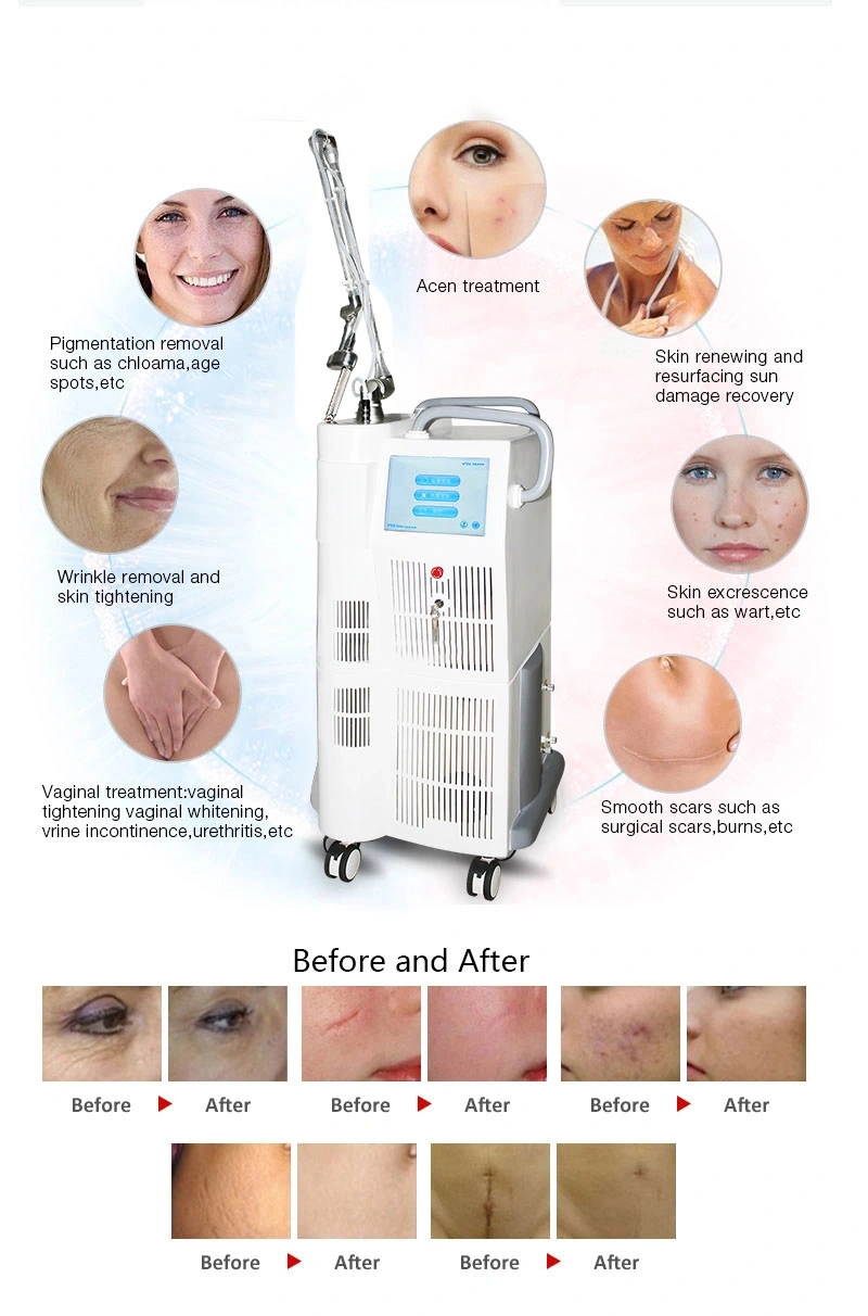 Acne Treatment CO2 Fractional Laser Cutting Multifunctional Laser Machine