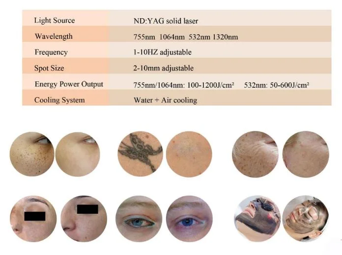 Good Quality Eyebrow Removal ND YAG Laser Picosecond Tattoo Removal Laser Machine for Carbon Peeling