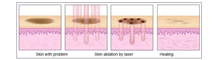 Plastic Salon SPA Clinic Used Most Effective CO2 Fractional Laser Acne Treatment Beauty Equipment