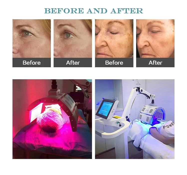 Facial Therapy Anti Aging Beauty Machine LED for Scar Removal