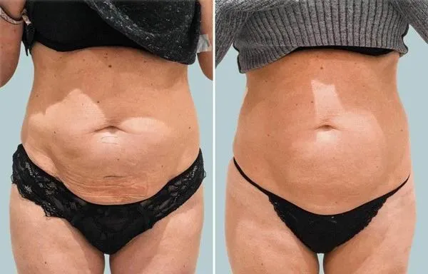 4 in 1 Wrinkle Removal Face Lift Vaginal Tightening Liposonix Body Slimming Hifu Anti-Aging Machine
