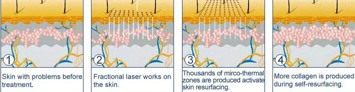 Best Hospital Use 10600 Nm CO2 Fractional Laser Wrinkle Removal Acne Scar Treatment Laser Equipment