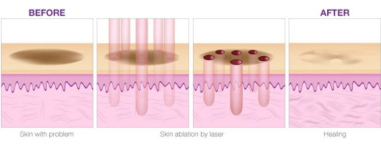 Tingmay CO2 Fractional Laser Vaginal Tightening and Skin Resurface Machine
