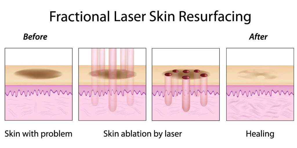 CO2 Fractional Laser Acne Scar Treatment Effective Medical Beauty Machine